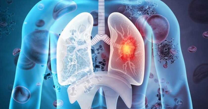 50 yaşın üzerindeki insanlar ve sigara içenler dikkatli olun! Uzmanlar uyarıyor: Çoğunlukla akciğer kanserini öldürüyor –