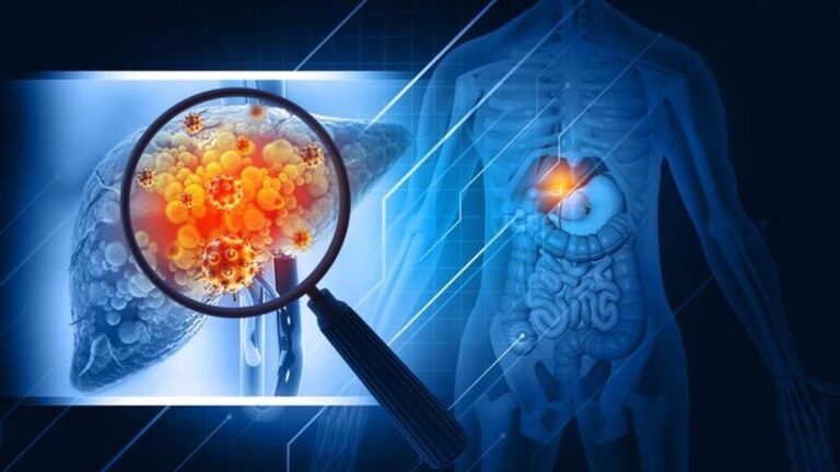 Karaciğer kanseri belirtileri nelerdir? Karaciğer Kanseri Nasıl Anlanır? Tedavi yöntemleri nelerdir?